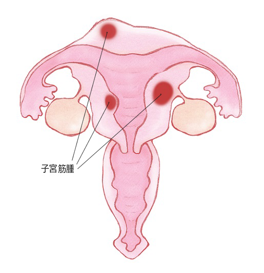 子宮筋腫