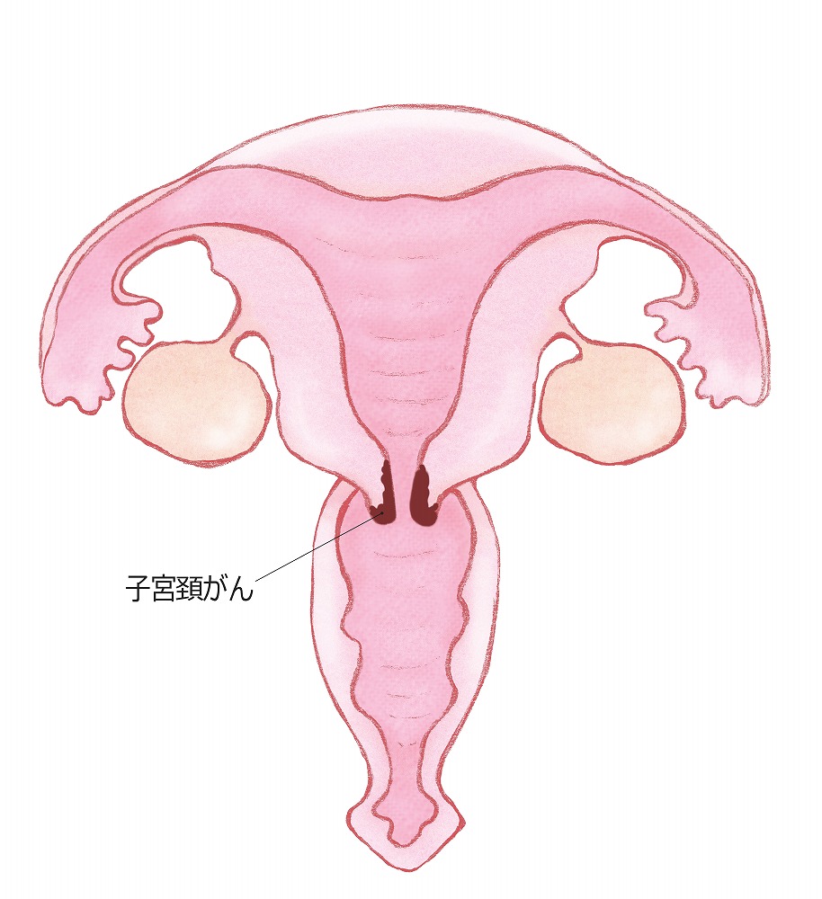 子宮 頚 管 ポリープ 悪性 だっ た