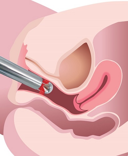 切開は不要で、腟にレーザーを照射するだけで腟を収縮させることができます。